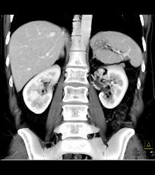 Collaterals Near Left Renal Hilum - CTisus CT Scan