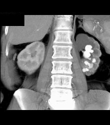 Staghorn Calculus Left Kidney - CTisus CT Scan