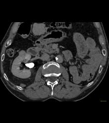 Left Nephrectomy With 1cm Tumor Right Kidney -see Sequence. Liver Lesion Was A Hemangioma. - CTisus CT Scan