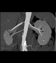 Renal Artery Stenosis. Right Renal Artery to Upper Pole and Stenosis of the Left Renal Artery. - CTisus CT Scan