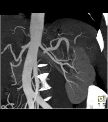 Infarcted Left Kidney Due to Stenosis of Upper Pole Renal Artery - CTisus CT Scan