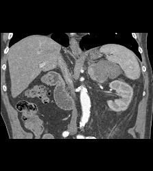 Bleed in Left Adrenal Gland That Has A Metastases From Renal Cell Carcinoma - CTisus CT Scan