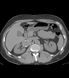 Right Renal Artery Aneurysm - CTisus CT Scan