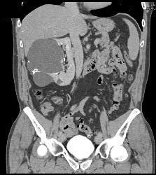 Complex Right Renal Cyst - CTisus CT Scan