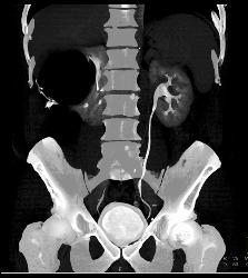 Complex Right Renal Cyst - CTisus CT Scan
