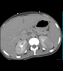 Bilateral Acute Pyelonephritis - CTisus CT Scan