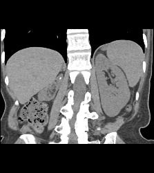 Atrophic Right Kidney - CTisus CT Scan