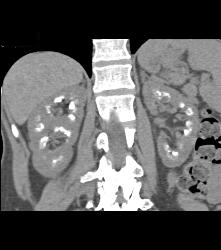 Medullary Sponge Kidney - CTisus CT Scan