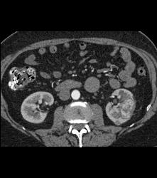 Hypervascular Left Renal Cell Carcinoma - CTisus CT Scan