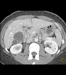 Normal Nephrographic Phase - CTisus CT Scan