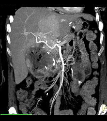 Recurrent Necrotic Tumor in Right Renal Bed - CTisus CT Scan