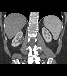 3 Cm Angiomyolipoma (AML) - CTisus CT Scan