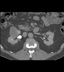Cystic Renal Cell Carcinoma - CTisus CT Scan