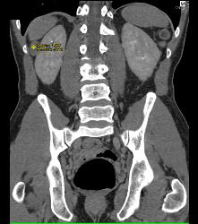 Dense Renal Cyst - CTisus CT Scan