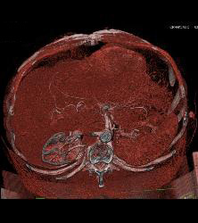 Post Left Nephrectomy Bed - CTisus CT Scan