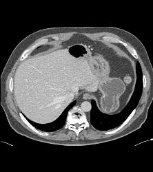 Post Left Nephrectomy Bed - CTisus CT Scan