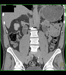 Distal Right Ureteral Tumor - CTisus CT Scan