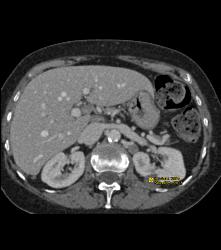 Complex Left Renal Cyst - CTisus CT Scan