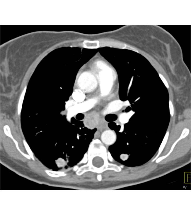 Vascular Renal Cell Carcinoma (Clear Cell) with Liver and Lung Metastases - CTisus CT Scan