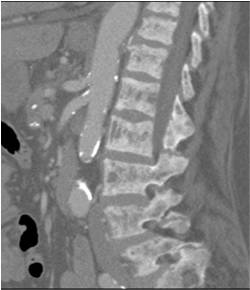 Renal Osteodystrophy - CTisus CT Scan