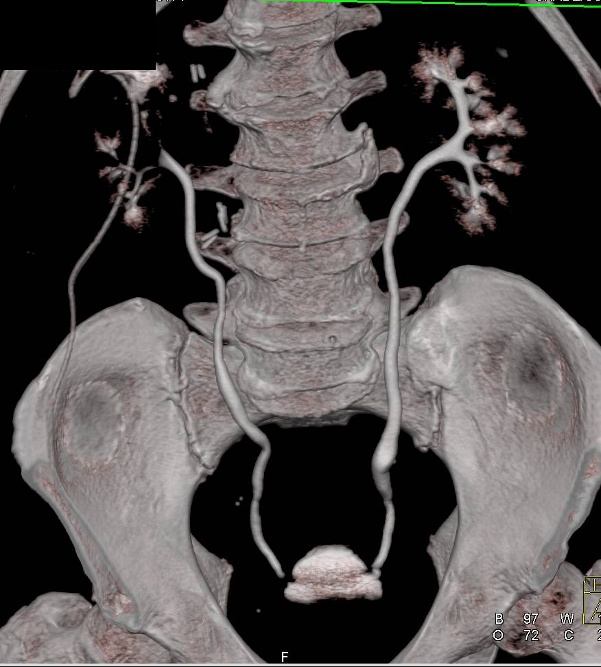 Partial Right Nephrectomy with Contrast Extravasation from Upper Pole Calyx on CT Urography - CTisus CT Scan