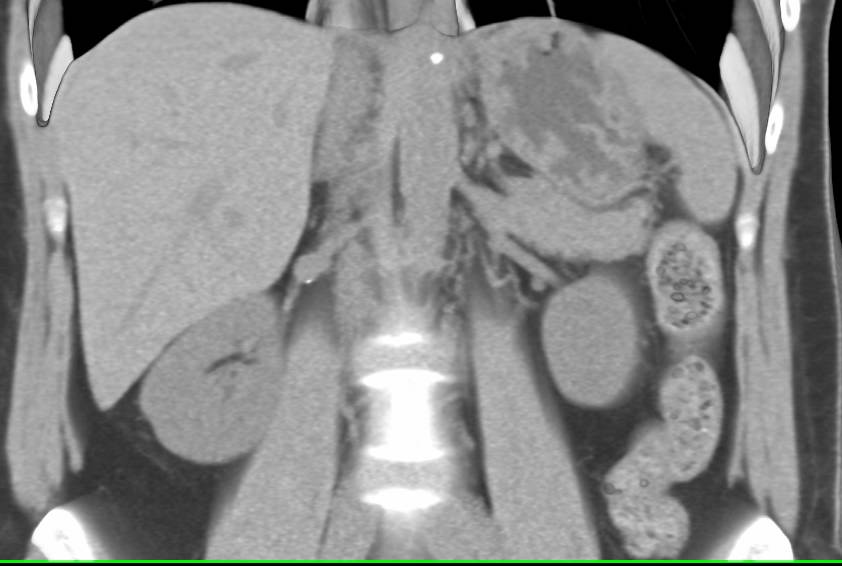 Right Renal Artery Aneurysm in Patient with Hematuria. Excellent CT Urogram with Ureter Tracking also Provided - CTisus CT Scan
