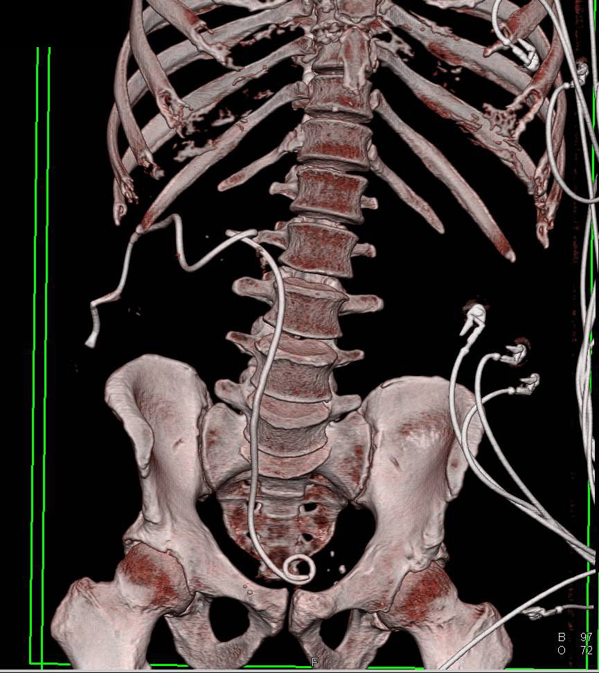 Nephrostomy Tube in a Patient with Transitional Cell Carcinoma of the Renal Pelvis on the Right - CTisus CT Scan