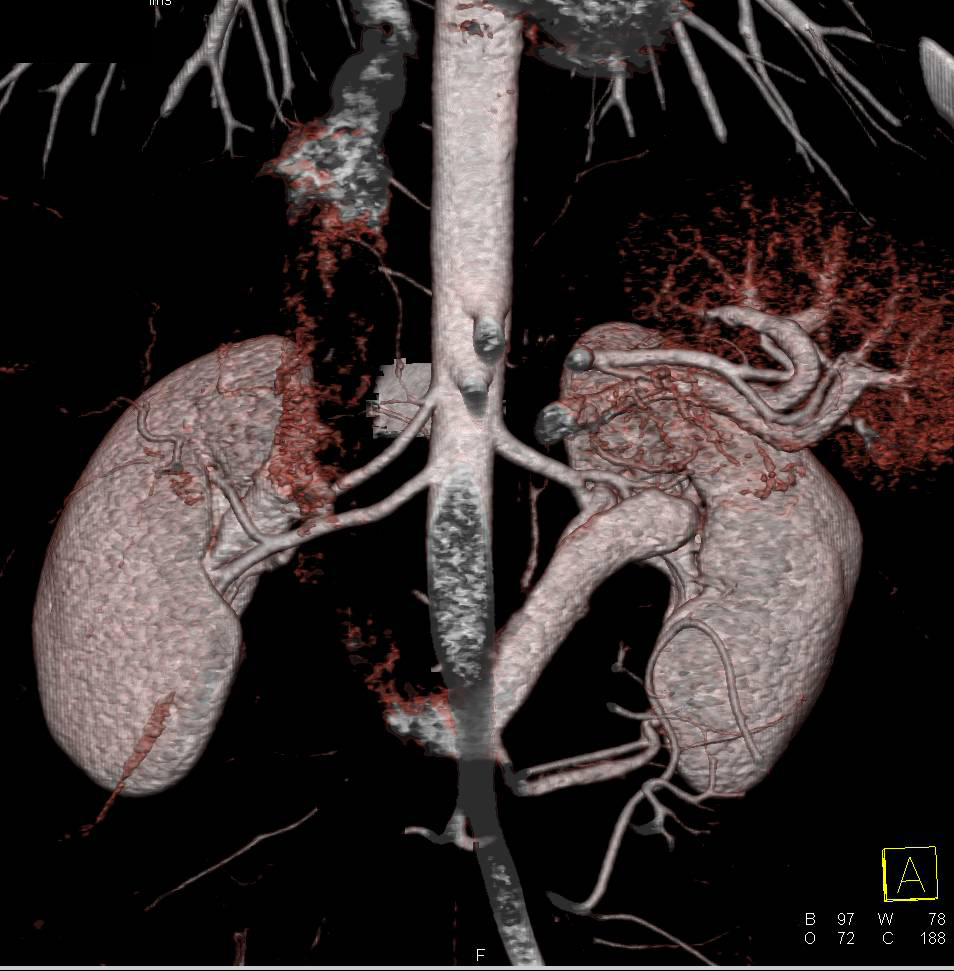 Retroaortic Left Renal Vein - CTisus CT Scan