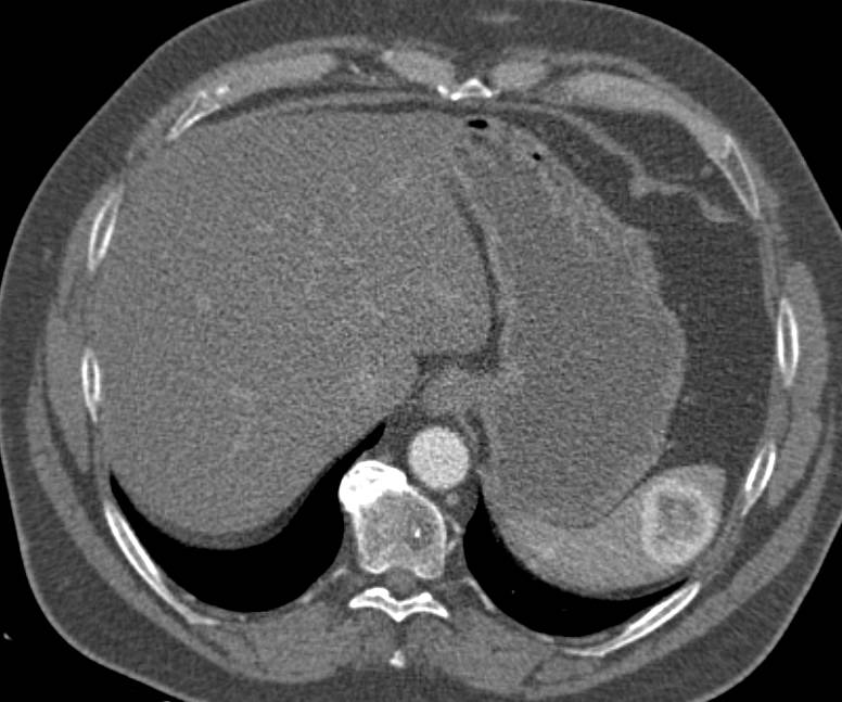 Recurrent Renal Cell Carcinoma Metastatic to the Spleen - CTisus CT Scan