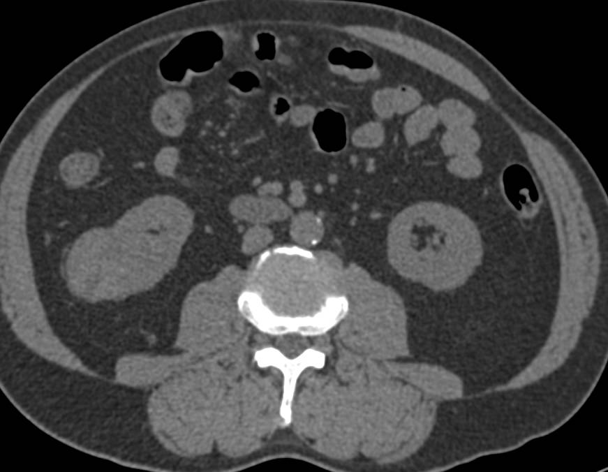 3D Mapping of a Papillary Renal Cell Carcinoma - CTisus CT Scan