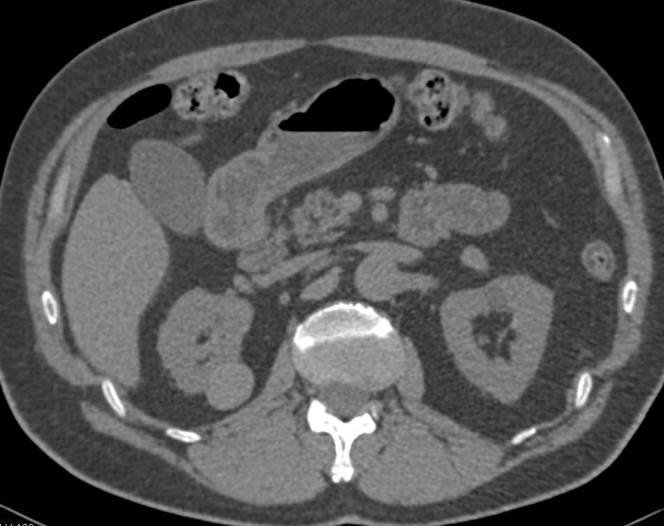 High Density Renal Cyst with Multiple Phases and Displays - CTisus CT Scan