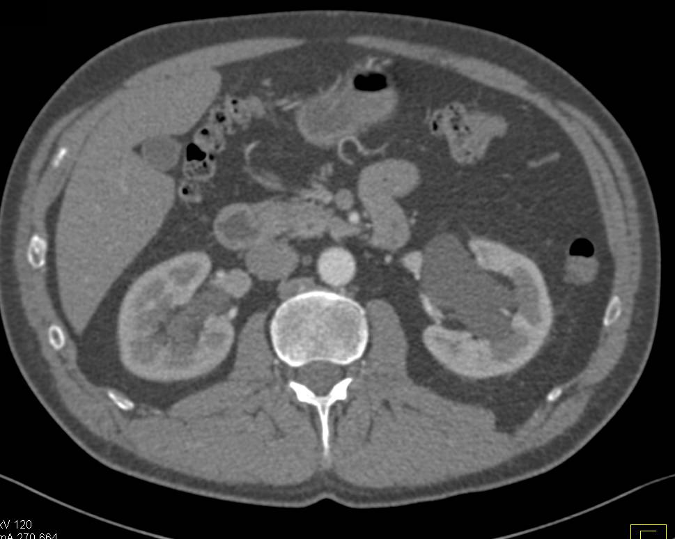 Left Hydronephrosis due to Subtle Stone in Right Ureter - CTisus CT Scan