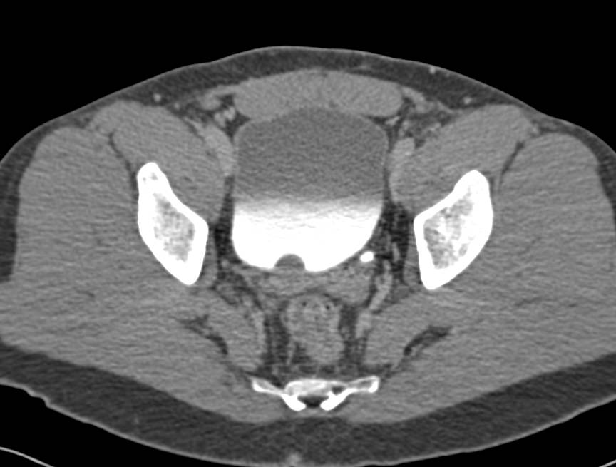 Chronic Pyelonephritis with Blunted Calyces - CTisus CT Scan