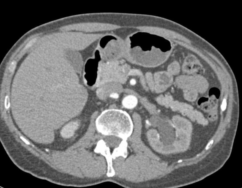 Carcinoma of the Ureterovesical Junction (UVJ) with Left Hydronephrosis - CTisus CT Scan