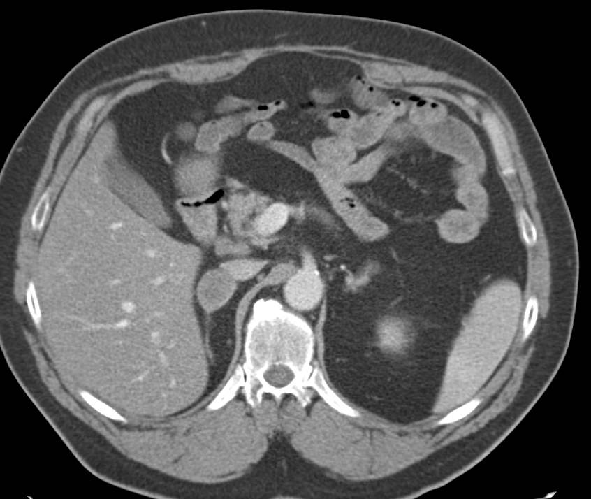 Metastatic Renal Cell Carcinoma to Adrenal, Lung and Spleen - CTisus CT Scan