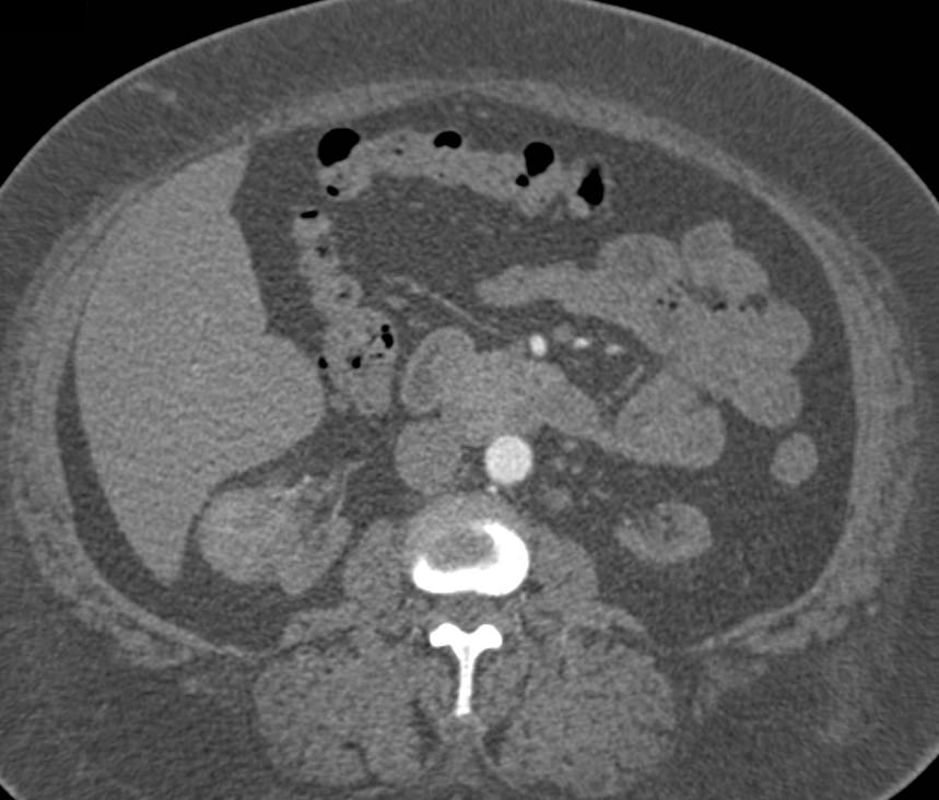 Right Renal Cell Carcinoma in Patient with End Stage Renal Disease - CTisus CT Scan