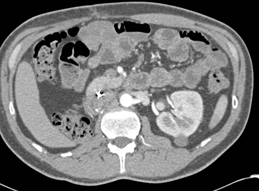Normal Right Nephrectomy Space with High Density Left Renal Cyst - CTisus CT Scan