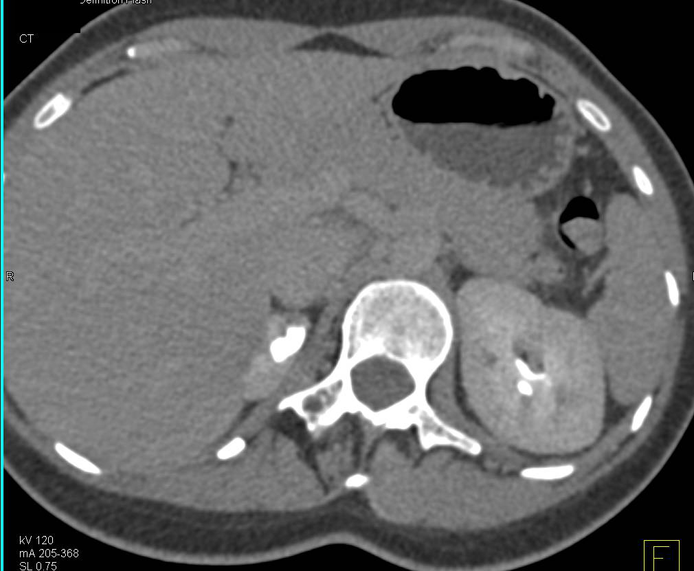 Chronic Pyelonephritis with Blunted Calyces (Right Kidney) - CTisus CT Scan