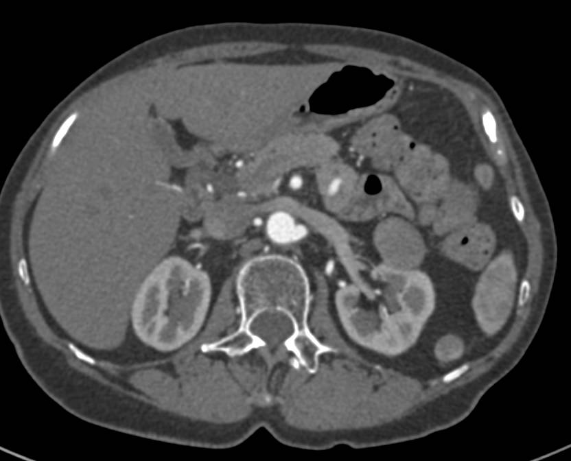 Beautiful Example of a High Density Renal Cyst Simulating a Papillary Renal Cell Carcinoma - CTisus CT Scan