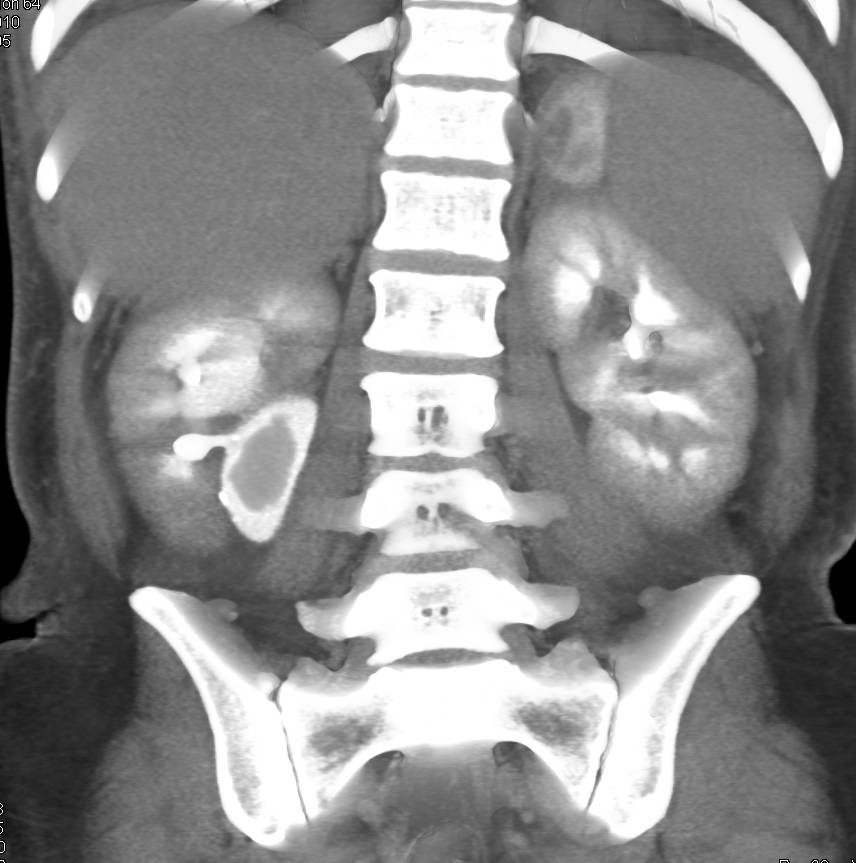 Blood Clot in Right Renal Pelvis - CTisus CT Scan