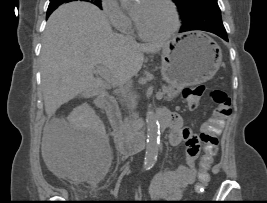 Abscess Adjacent to Partial Nephrectomy Site - CTisus CT Scan