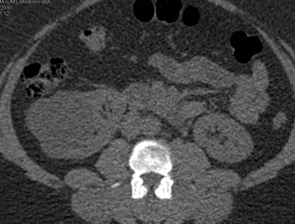 Complex Right Renal Cyst - CTisus CT Scan