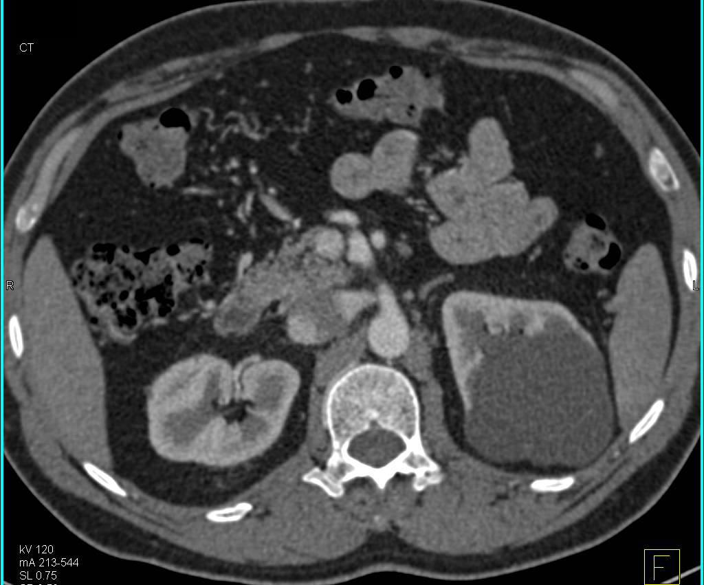 Bosniak II Cyst - CTisus CT Scan