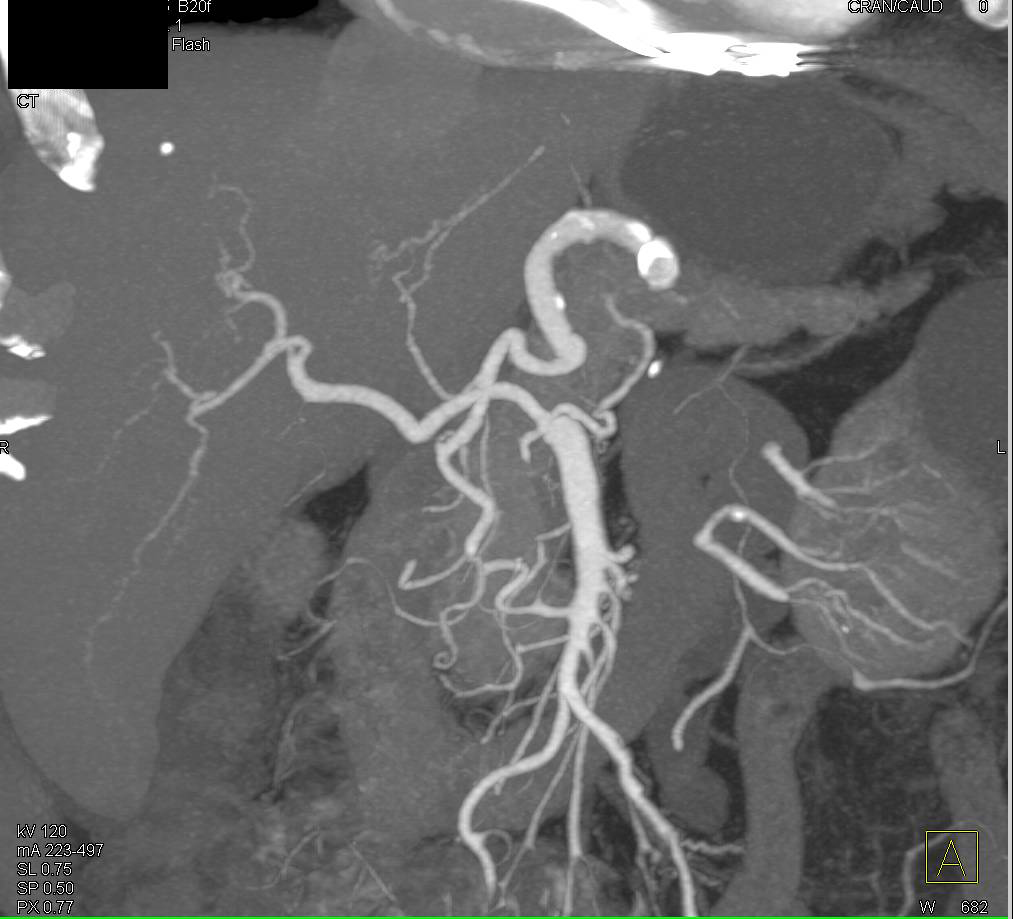 CTA Renal Arteries with Incidental Splenic Artery Aneurysm - CTisus CT Scan