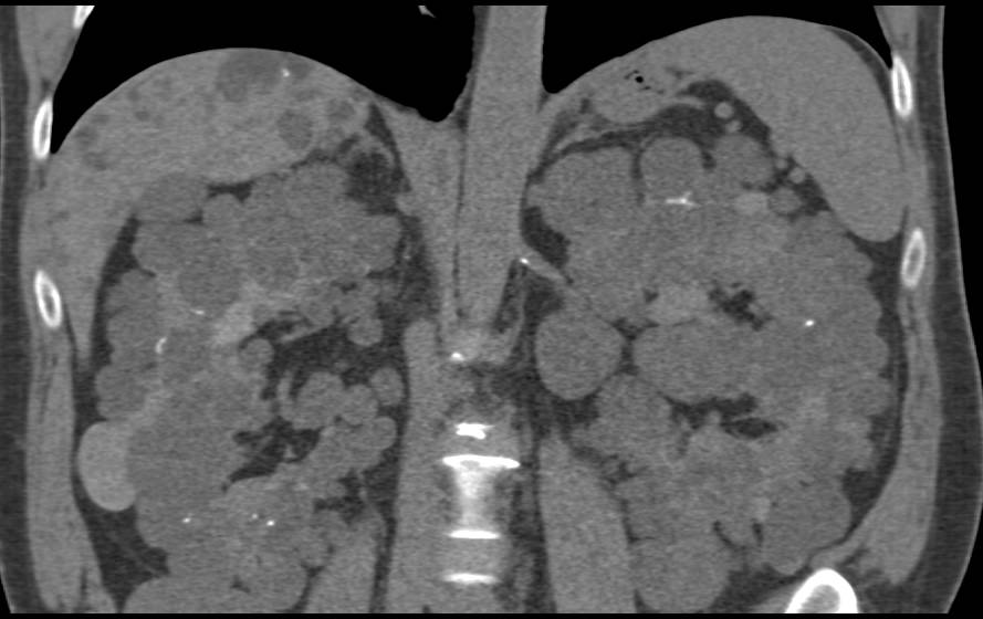 Polycystic Kidney Disease and Polycystic Liver Disease - CTisus CT Scan
