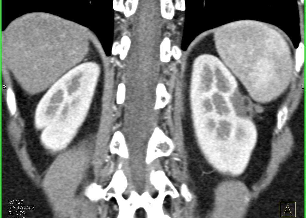 Post Cryo-Ablation Changes in the Left Kidney without Recurrence - CTisus CT Scan