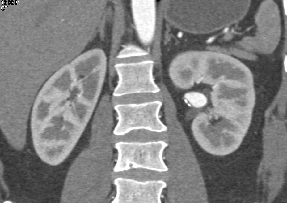 Left Renal Artery Aneurysm in 3D in Multiple Phases - CTisus CT Scan