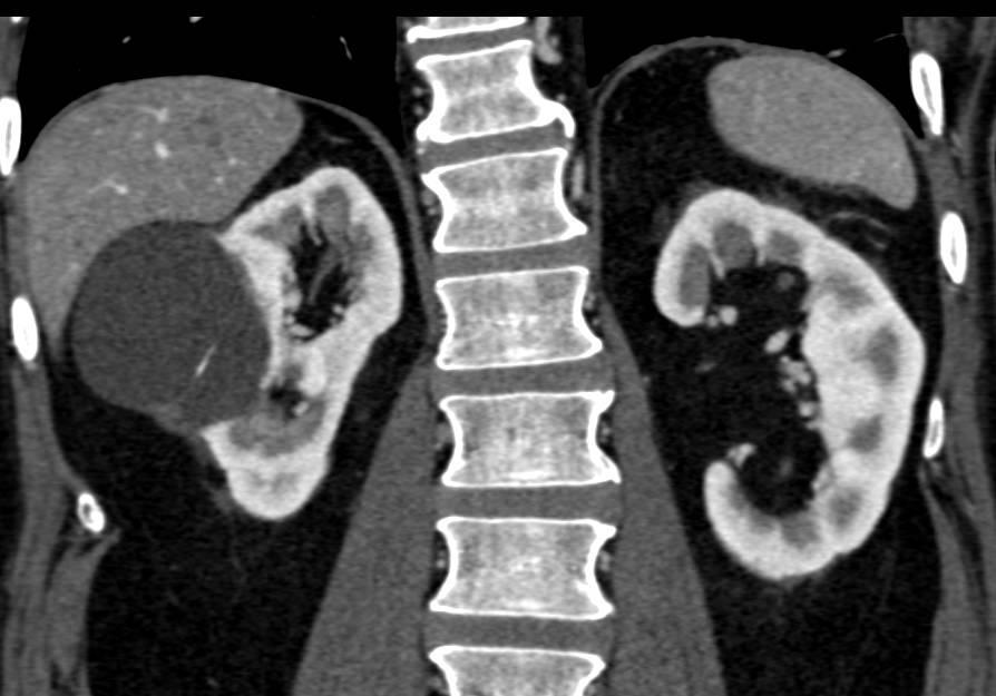 Bosniak 2 Cyst and Incidental Urachal Remnant - CTisus CT Scan