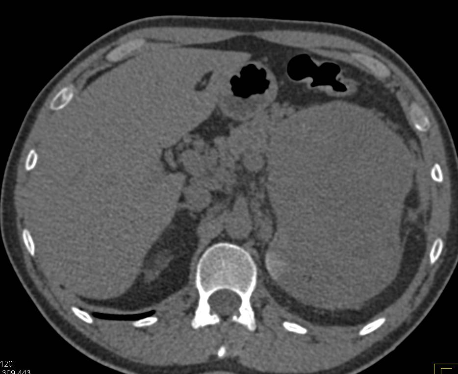 Excellent Example of Clear Cell Renal Carcinoma Invading Renal Vein and Inferior Vena Cava (IVC). Note the Huge Collaterals Present Near the Left Kidney - CTisus CT Scan