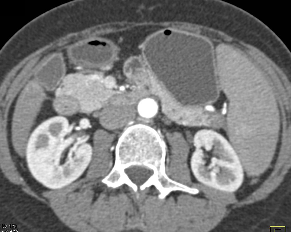 Right Renal Artery Aneurysm - CTisus CT Scan